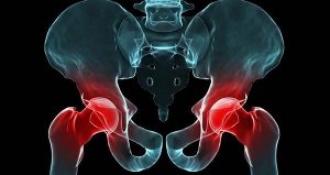 Bệnh thoái hóa khớp háng là gì? Triệu chứng và cách điều trị 